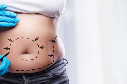 Mommy Makeover Dubai